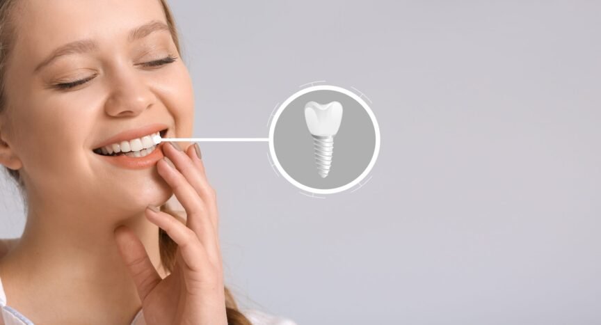 dental implants